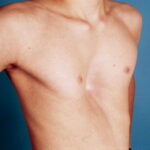 Pectus excavatum