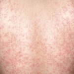 Pityriasis rosé de Gibert