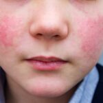 Cinquieme maladie (ou Érythème infectieux)