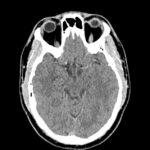 Hémorragie sous-arachnoïdienne (HSA)