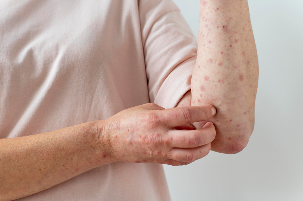pityriasis rosé