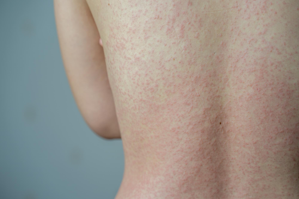 pityriasis rosé