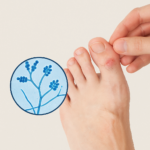 Mycose des ongles : comment reconnaître une infection à Trichophyton rubrum ?