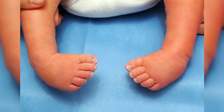 Varus du pied : causes, symptômes et traitements de cette déformation du pied Varus du pied