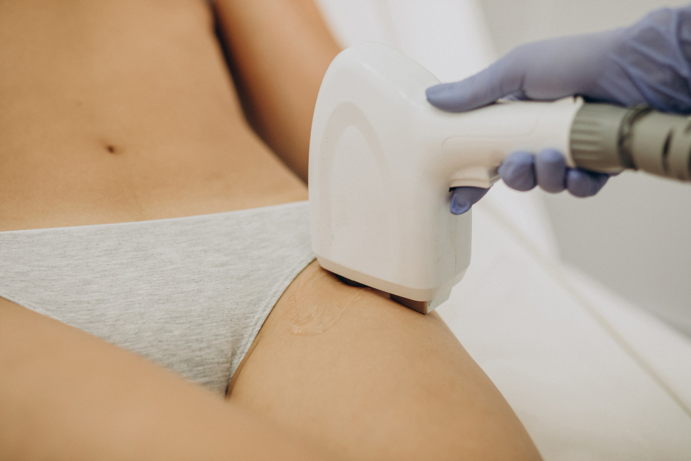 Brûlure épilation laser